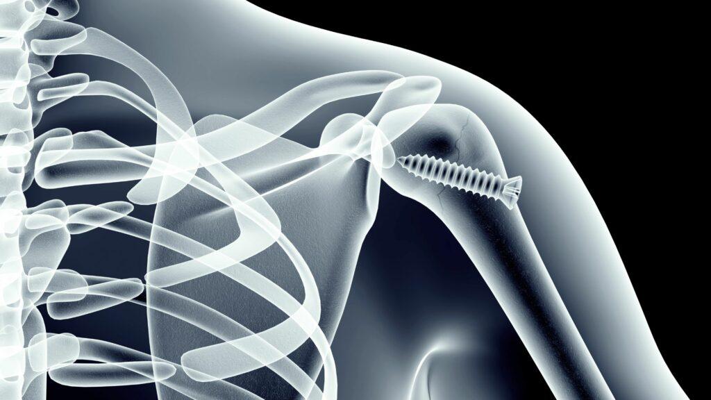 Bone Screws: Enhancing Orthopedic Procedures and Patient Outcomes
