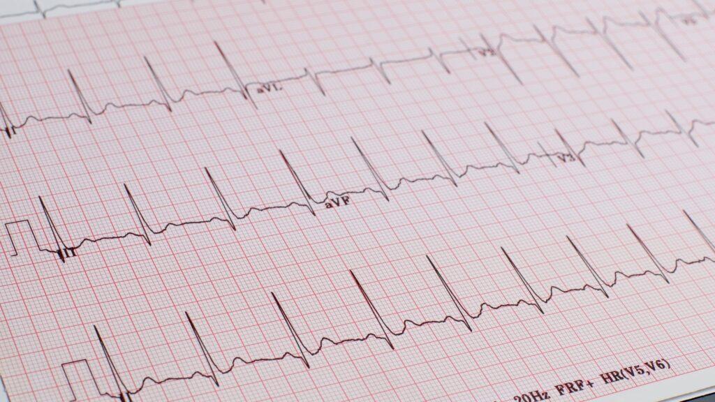 Exploring the Potential of Electrocardiograph (ECG) Machines: An In-depth Overview