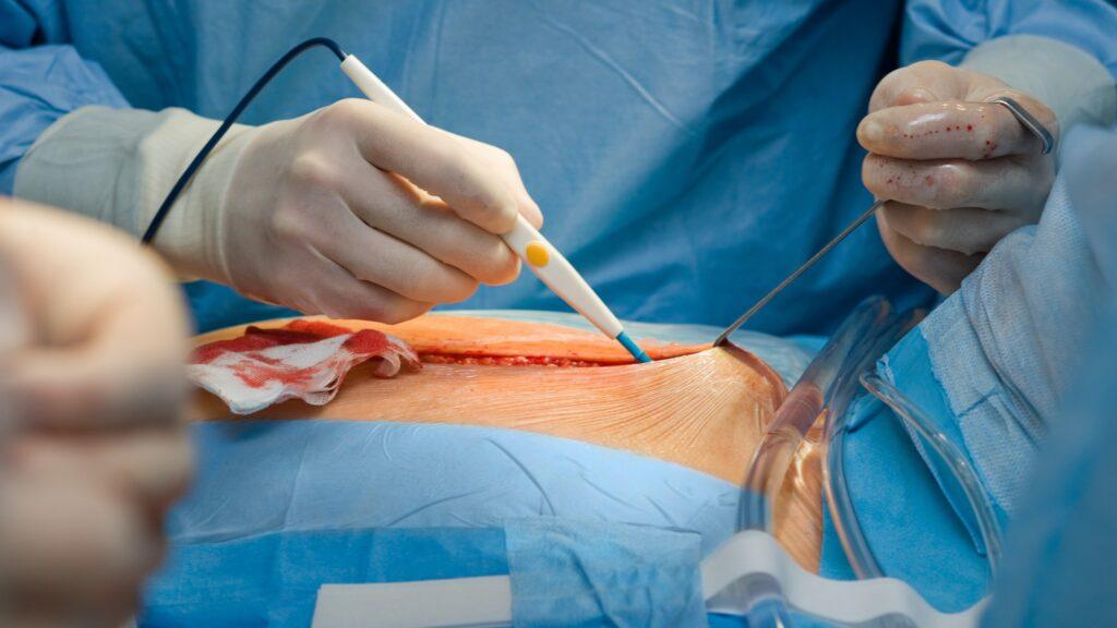 Enhance Surgical Precision: Exploring Electrosurgical / Cautery Pencils & Accessories