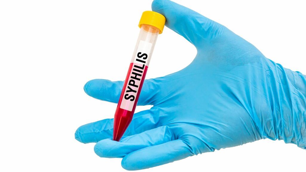 Unveiling the Power of Syphilis Test Kits: Accurate Diagnosis and Timely Treatment